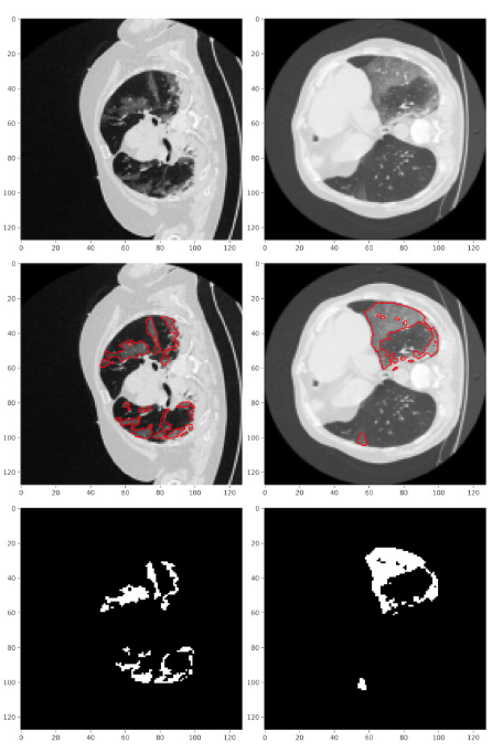 Use-case 1: Predicted infected regions in COVID-19 CT scan images